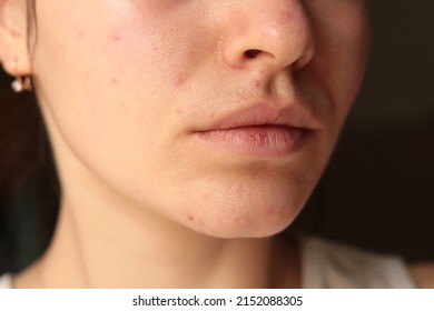 acne problem on chin. pimples on the face of a young girl. mustache in women
				
				