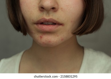 Acne Problem On Chin. Pimples On The Chin. Hormonal Imbalance, Skin Problems. Pimple In The Corners Of The Lips

