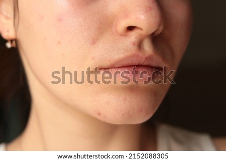 acne problem on chin. pimples on the face of a young girl. mustache in women

