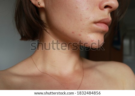 acne problem. pimple over the lip. focus on pimples. cometology. skin care
