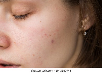 Acne Problem. Pimples On The Chin. Acne Problem On The Cheeks
