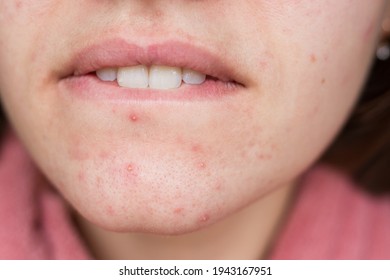 Acne Problem. Pimples On The Chin. Acne Problem On The Cheeks
