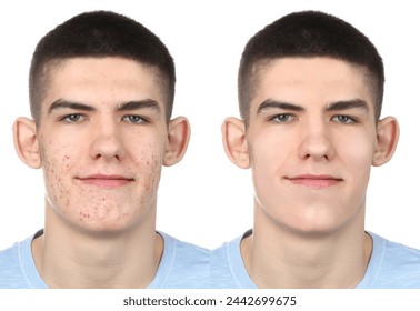 Acne problem. Young man before and after treatment on white background, collage of photos
