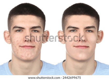 Acne problem. Young man before and after treatment on white background, collage of photos