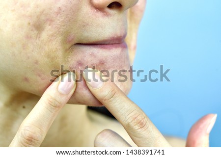 Acne pus, Close up photo of acne prone skin problem, Woman squeezing pimple with dirty bare hands, Removing whitehead acne from face and left lesion scar.
