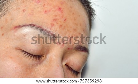 Acne pus, Macro shot of acne prone skin. Acne skin because the disorders of sebaceous glands productions.Girl with problematic skin and scars. Skin care and facial acne treatment 