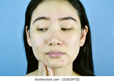 Acne Scar Skin Facial Problem Asian Stock Photo 1524239732 | Shutterstock