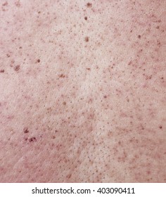 acne scars in the back. Human skin texture. skin of woman 