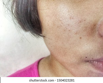 Acne Scars, Black Pus Scars And Pimples On A Woman's Face Concepts Of Surface Problems And Harmonic Failures