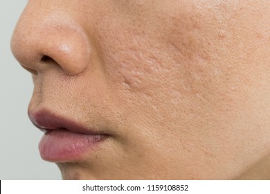 Acne Scars On Asian Man' Face. Close Up For Large Pores Skin And Deep Acne Scars.