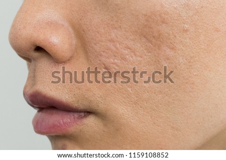 Acne scars on Asian man' face. Close up for large pores skin and deep acne scars.