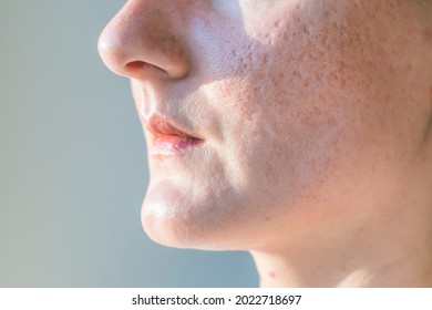 Acne Scars On A Woman Is Face Close-up.