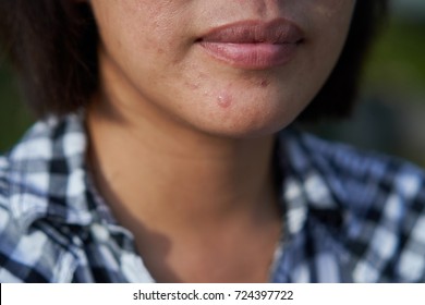 Acne , Acne Scars,  Sweat On The Woman Chin Area.