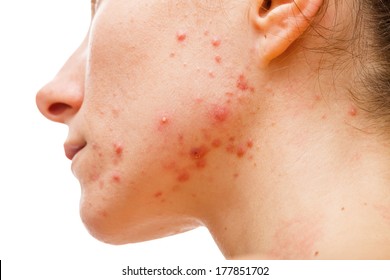 Acne skin because the disorders of sebaceous glands productions