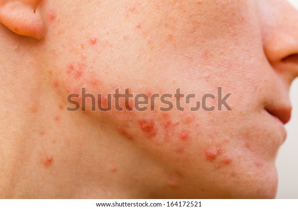 Acne Skin Because Disorders Sebaceous Glands Stock Photo Edit Now