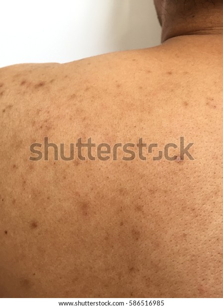 Acne Skin Dark Spots Scar On Stock Photo Edit Now 586516985