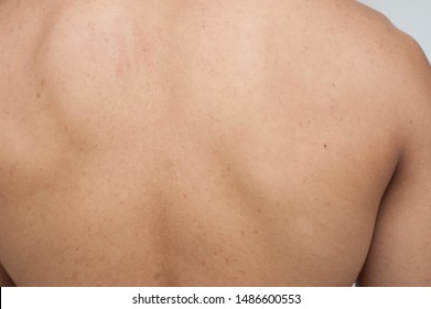 Acne Skin. Acne Skin On The Back. Human Skin.