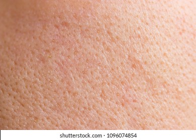 Acne skin on face woman,problem skin. macro