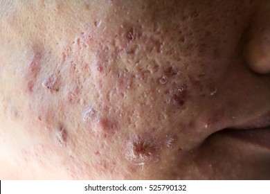 Acne skin on woman surface