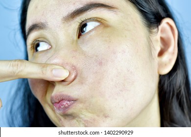 4,622 Acne bacteria Images, Stock Photos & Vectors | Shutterstock