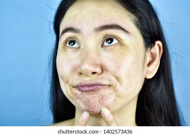 Acne Skin Problem Asian Woman Annoy Stock Photo 1402573436 | Shutterstock