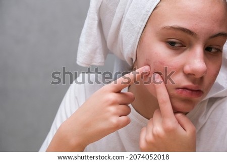 Acne. A teenage girl squeezing out a pimples on her face in front of a mirror. Problematic skin in adolescence. skin care