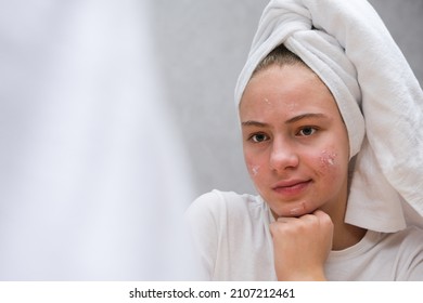 Acne. A teenage girl twisted her face, which she does not like because of acne. Problematic teenage skin. Care for problem skin. acne remedy.