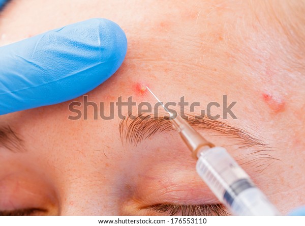 Acne Treatment Injection On Sebaceous Glands Stock Photo Edit Now