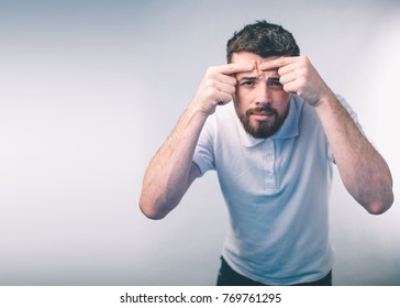 Acne treatment. Acne man squeezing his pimple, removing pimple from her face. Man skin care concept. Acne spot pimple spot skincare beauty care male pressing on skin problem face.