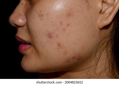 Acne Vulgaris, Black Spots And Scars On Face Of Asian Young Woman.  Closeup View.