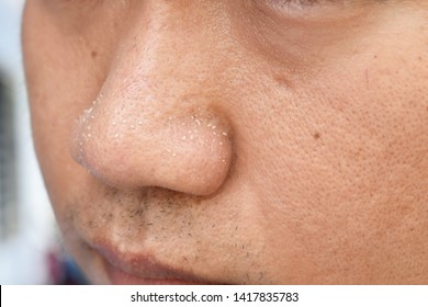 Acne Vulgaris On Nose Of Asian Man