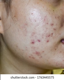 Acne Vulgaris Images Stock Photos Vectors Shutterstock