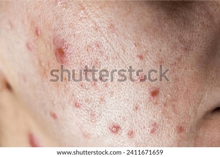 acne.Close up of man with problematic skin and scars from acne