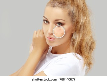 Acne.Post-Acne Marks /Treating Acne Scars