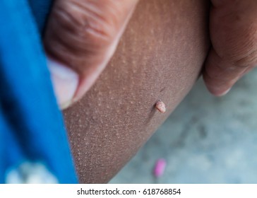 Acrochordon Or Cutaneous Skin Tag