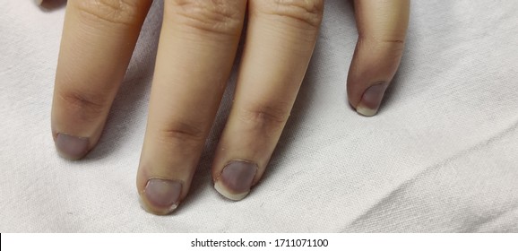 Acrocyanosis and purpura fulminans on distal fingers on white background of pediatric septic shock patient in hospital