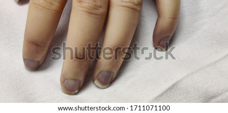 Acrocyanosis and purpura fulminans on distal fingers on white background of pediatric septic shock patient in hospital