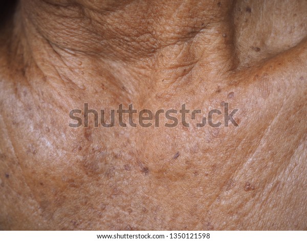 Actinic Keratosis Seborrheic Keratosis On Collarbone Stock Photo