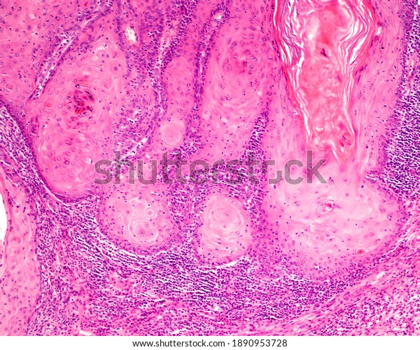 Actinic Senile Keratosis Light Micrograph Showing Stock Photo ...