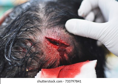 active bleeding open wound at scalp , cut wound 