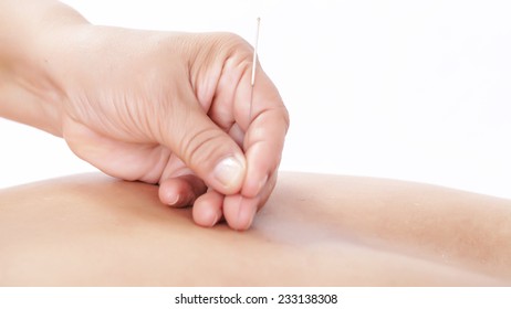 Acupuncture 