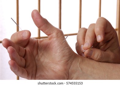 Acupuncture Of Hand And Fingers