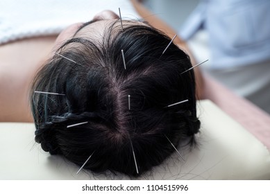 Acupuncture To The Head .hair Glabrous