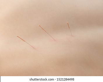 acupuncture, needle in skin dorsum, closeup photo