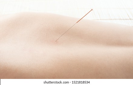 acupuncture, needle in skin dorsum, closeup photo