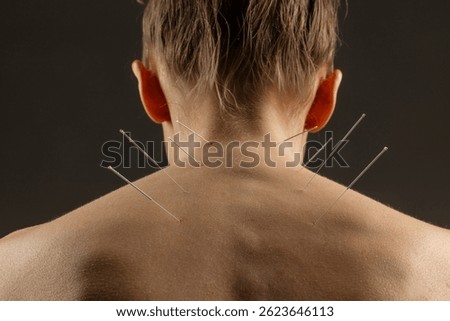 Acupuncture needles inserted into upper back of woman during therapeutic session for pain relief and balance.