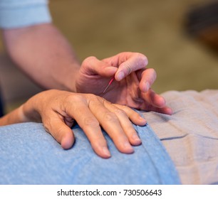 Acupuncture On A Hand