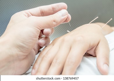 Acupuncture Patient With Needles Along Arm. Carpal Tunnel Syndrome Treatment 