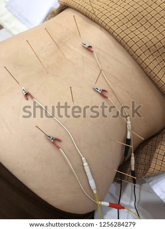 Acupuncture therapy by a specialist doctor