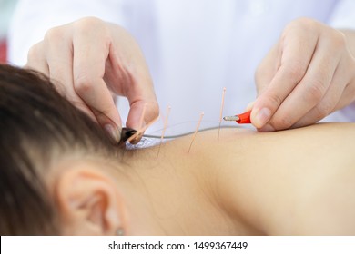 Acupuncturist inserts needles into a person's neck skin to reduce neck pain.